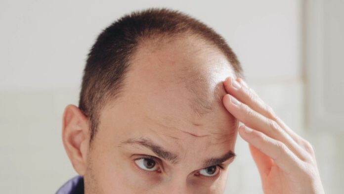 ¿que-sabemos-del-medicamento-que-aprobo-la-fda-contra-la-alopecia?-–-cnn-en-espanol