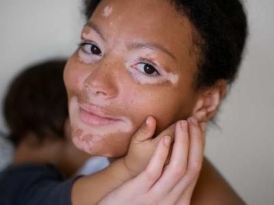 vitiligo,-afeccion-de-la-piel-frecuente